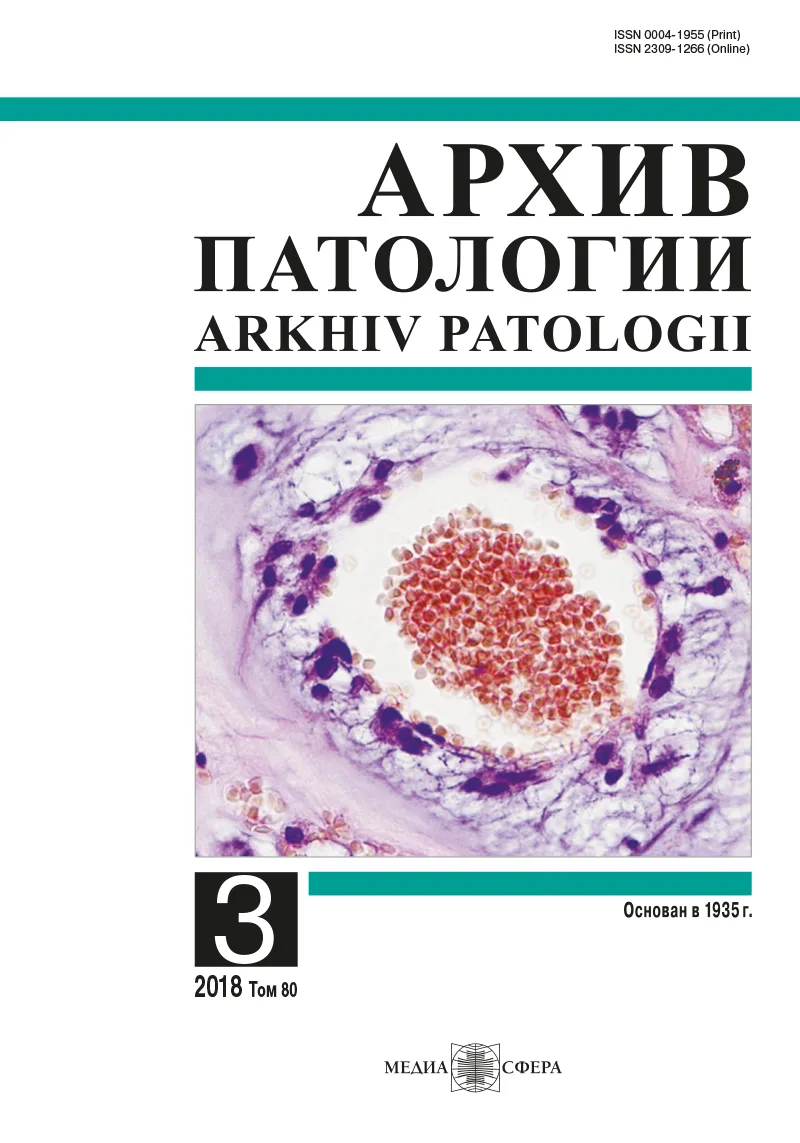 Лактотрофные аденомы гипофиза, резистентные к лечению агонистами дофамина: гистологическая и иммуногистохимическая характеристика