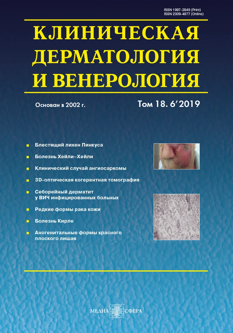 Себорейный дерматит у ВИЧ-инфицированных больных