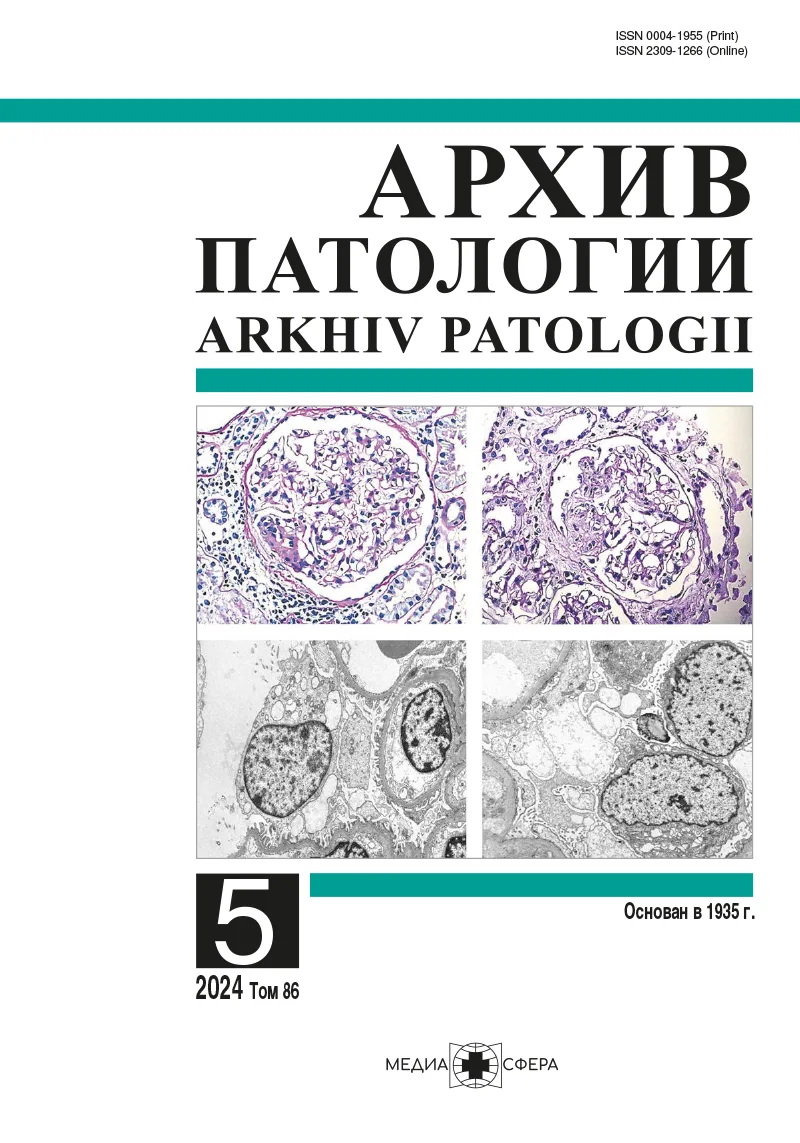 ALDH1-, CD133-, CD34-позитивные раковые стволовые клетки в аденокарциноме легкого у пациентов, перенесших новую коронавирусную инфекцию SARS-CoV2